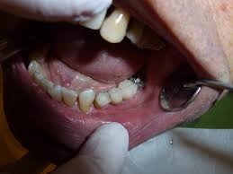 dental bonding